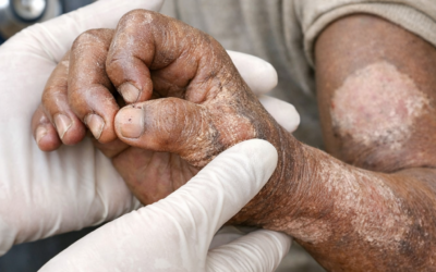Health Officials Urge Vigilance as Leprosy Cases Emerge in Otuke